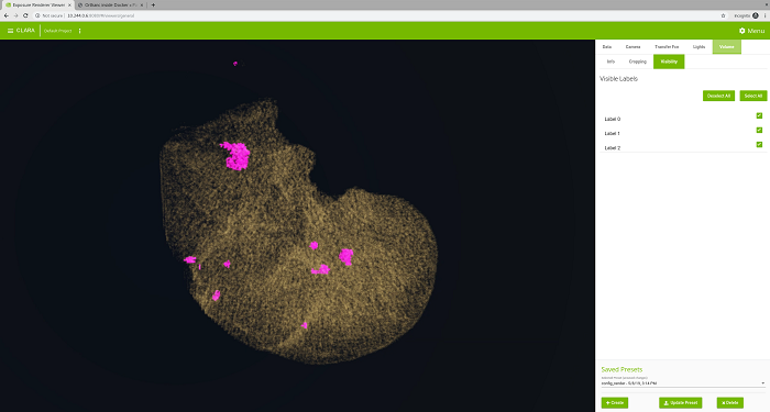 Ailments on segmented liver identified by Clara AI Toolkit