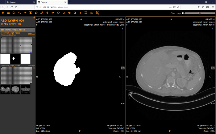 Oviyam2-viewer demonstreert zij-aan-zijaanzicht van Clara AI verwerkt versus originele CT-scan